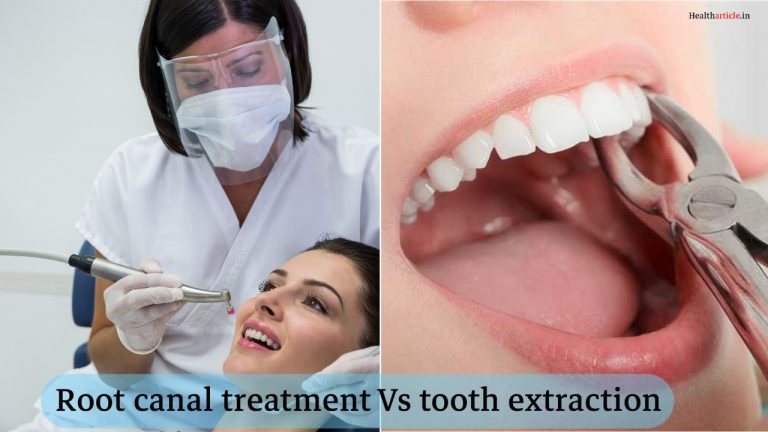 Root canal treatment Vs Tooth extraction
